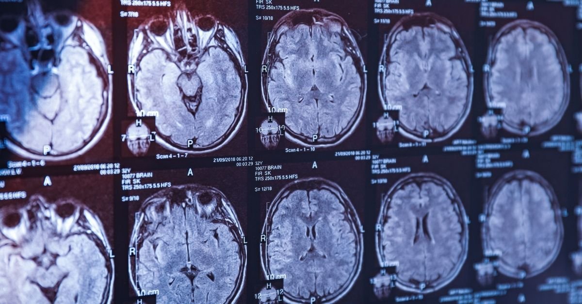Traumatic Brain Injury Dialogue- Buddhi Clinic